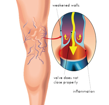 endovascular treatment in vizag