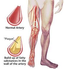 peripheral vascular disease